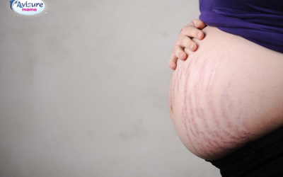 Rạn da khi mang thai phải làm gì?