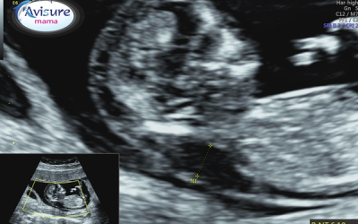 Những thông tin về siêu âm độ mờ da gáy mẹ cần biết