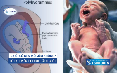 Đa ối có nên mổ sớm không? Lời khuyên cho mẹ bầu đa ối từ chuyên gia