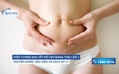 Hiện tượng đau vết mổ khi mang thai lần 2: Nguyên nhân, dấu hiệu và cách xử lý 