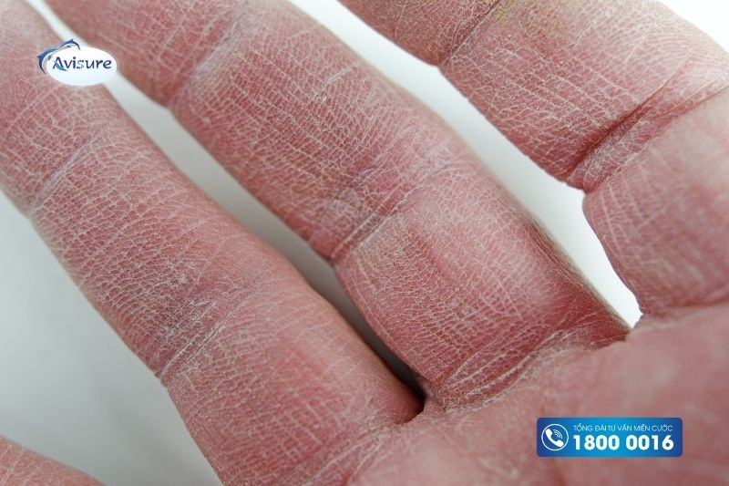 19 dấu hiệu bà bầu mang thai nghén con trai bàn tay khô