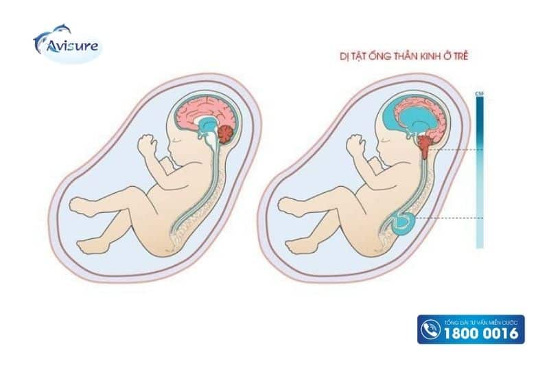 5-mthf có tác dụng ngừa dị tật ống thần kinh