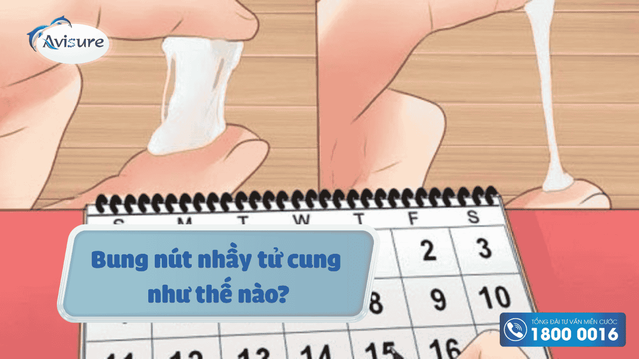 Bung nút nhầy như thế nào
