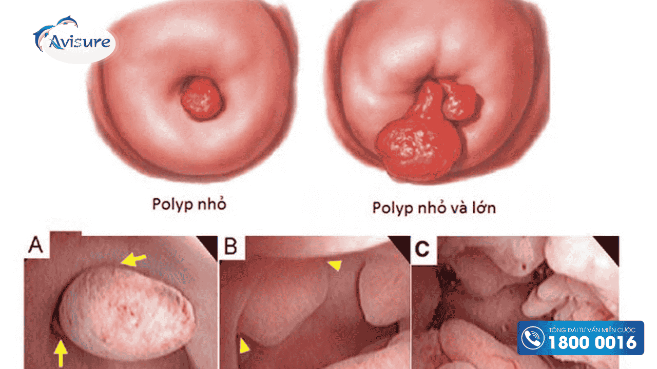 Polyp cổ tử cung 
