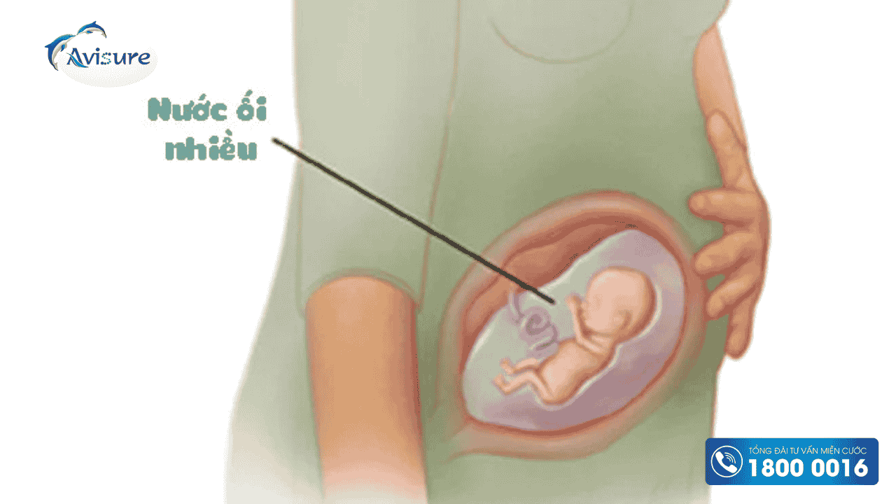 Tìm hiểu về hiện tượng dư ối 