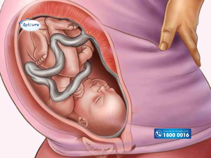 Tìm hiểu về dây rốn quấn cổ đặc biệt ở tuần 35