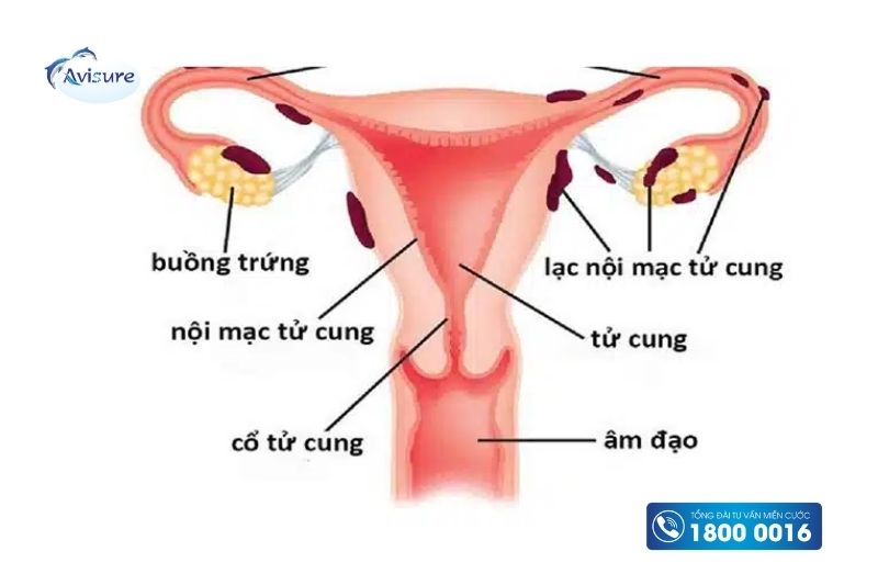 nguyên nhân khó thụ thai lần 2 lạc nội mạc tử cung