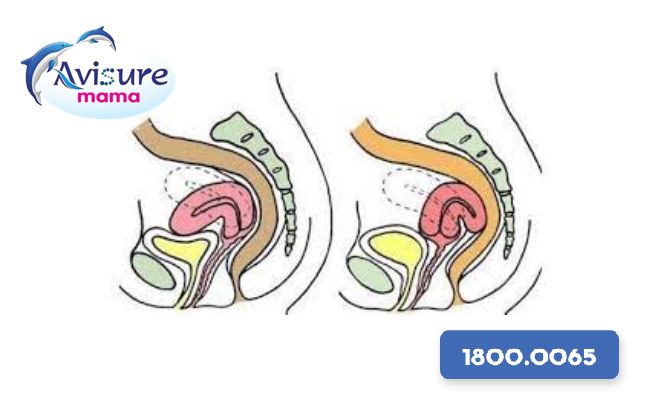 Tử cung ngả sau hay ngả trước khó có thai?