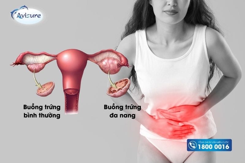 tăng cân khi uống thuốc bổ trứng do buồng trứng đa nang