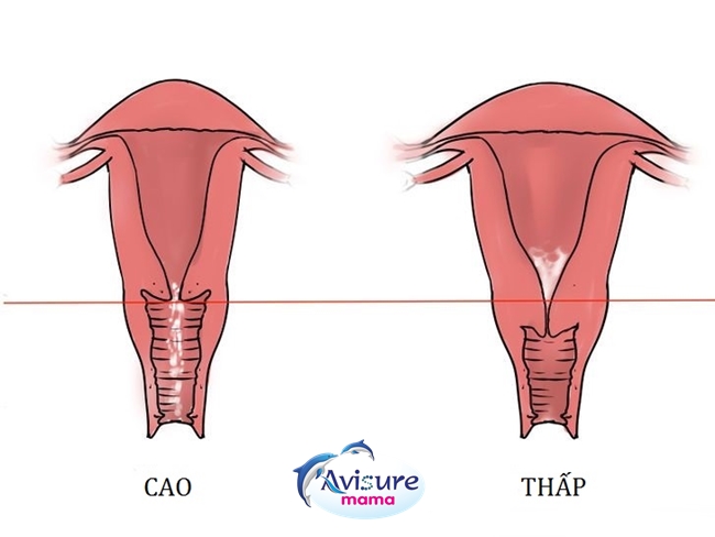 Tử cung cao: Những điều bạn cần biết về sức khỏe sinh sản