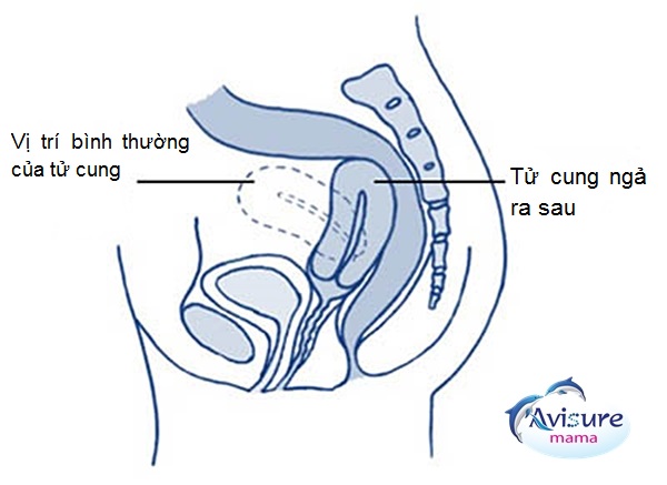 Tử cung ngả sau hay ngả trước khó có thai?